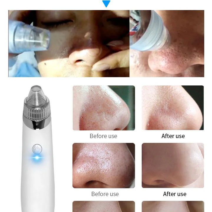 Blackhead remover beauty instrument electric cleanser facial pore cleaner blackhead remover